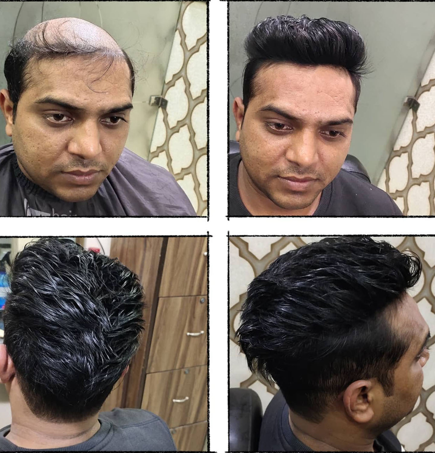 Best hair patch in delhi starting 2999/- hair wigs in delhi,wigs for cancer  patients men and women
