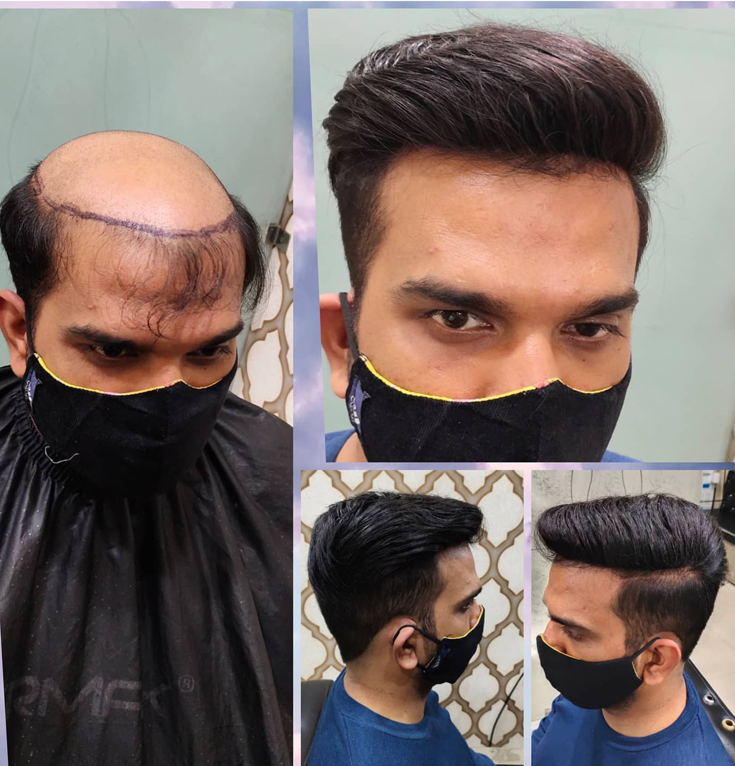 Best hair patch, Best hair patch in Delhi ,Best hair replacement , Best hair  fixing in Delhi
